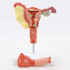 Pathological Model Female Reproductive System