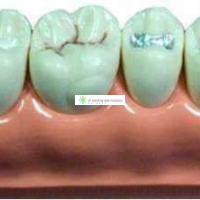 Pit and Fissure Sealing Treatment Teeth